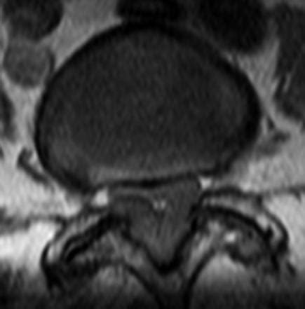 What Is Ligamentum Flavum Hypertrophy