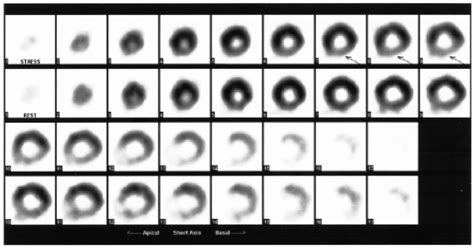 Technetium M Sestamibi Scan Showing Inferior Ischemia Arrows