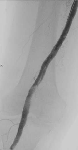 Remote Endarterectomy for an Occluded Superficial Femoral Artery (SFA ...