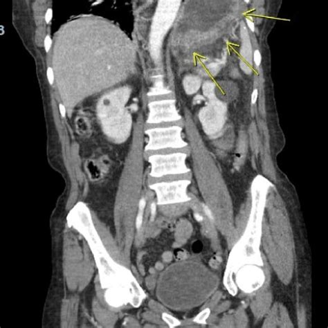 A Computerized Tomography Scan Of The Abdomen And Pelvis Demonstrating