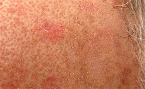 Actinic Keratosis Keratoses Symptoms And Treatment Wiki Itchy Mind