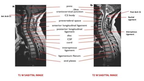 MRI Spine Anatomy