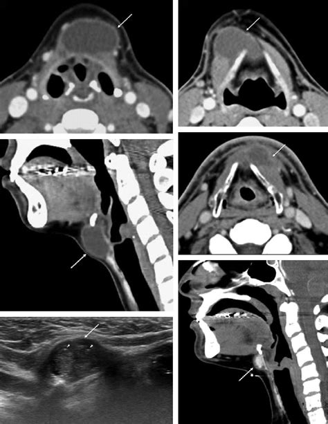 Thyroglossal Duct Cyst A B Axial And C Sagittal Contrast Enhanced