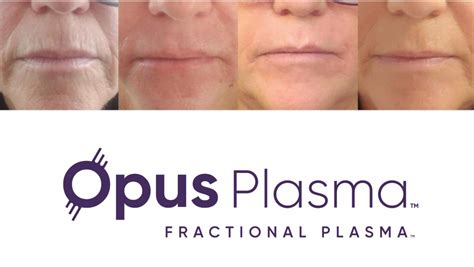 Opus Plasma Skin Resurfacing Shot Shop Med Spa