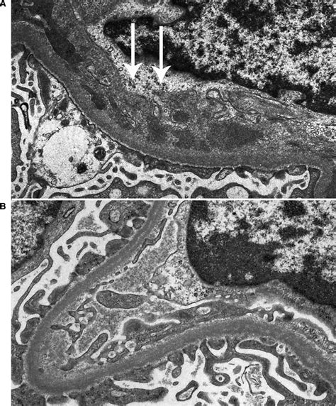 Membranoproliferative Glomerulonephritis Subendothelial Deposits