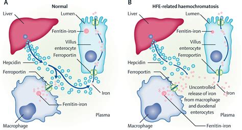 Hemochromatosis Gene