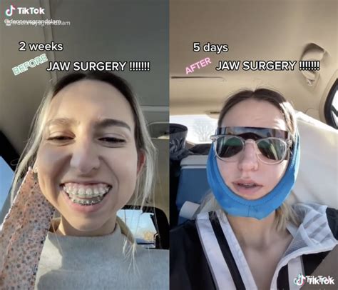 Woman Leaves TikTok Speechless With Post Jaw Surgery Transformation I