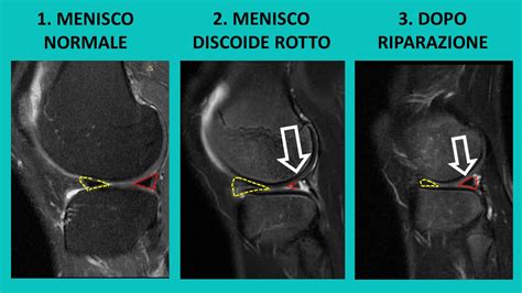 Menisco Esterno Discoide Alberto Grassi