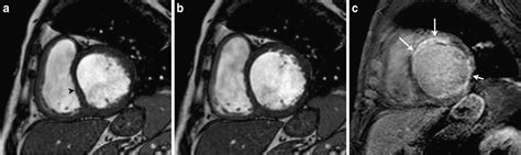 A 24 Year Old Woman Presenting With Dyspnoea On Exertion Who Had A