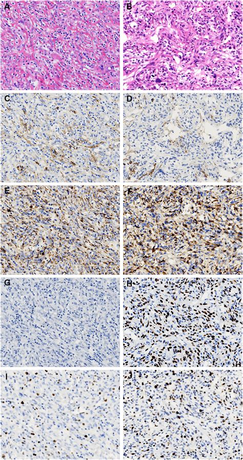 Frontiers Case Report The Stroma Rich Variant Of Castleman’s Disease Of Hyaline Vascular Type