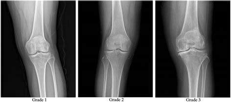 Osteoarthritis of the knee Kellgren-Lawrence grade 1, 2, and 3. | Download Scientific Diagram