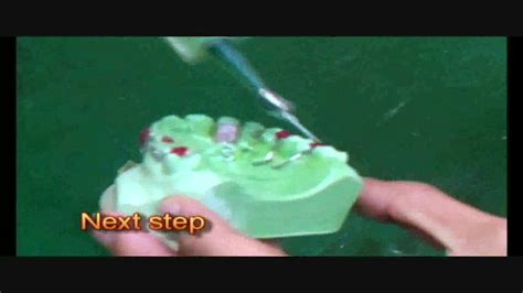 Anterior Bite Plane Removable Orthodontic Apliance Youtube