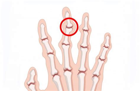 ¿cómo Evitar Deformaciones Por Artritis 5 Consejos Naturales Nuevas Evas