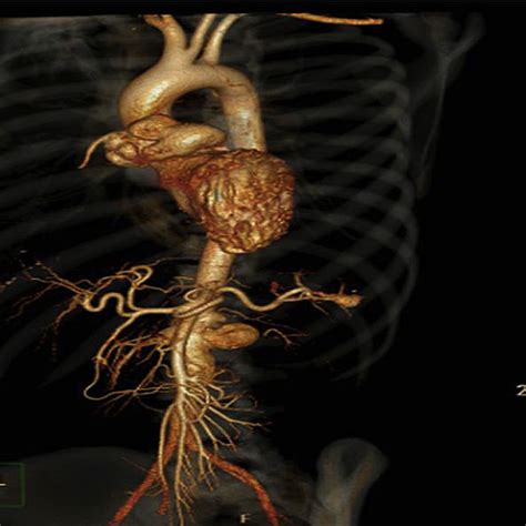 e 3D reconstructed CT angiography image of aorta and its branches. Note ...