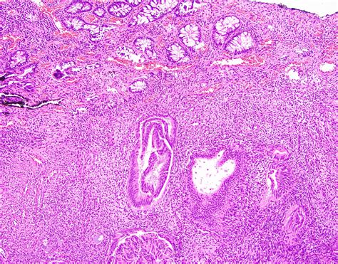 Pathology Outlines Endometriosis 9888 Hot Sex Picture