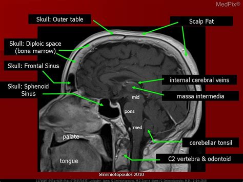 Sagittal Brain Mri