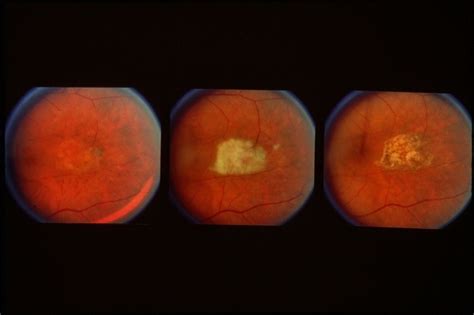 Central Serous Retinopathy - Retina Image Bank