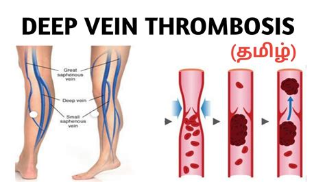 Deep Vein Thrombosis Causes Risk Factor Symptoms Treatment தமிழ் Youtube