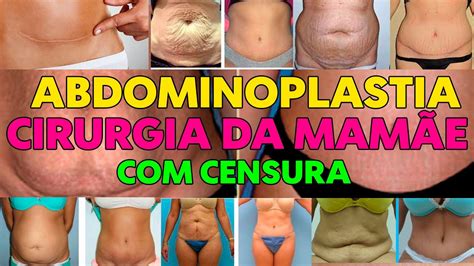 Abdominoplastia Antes E Depois Censura Youtube