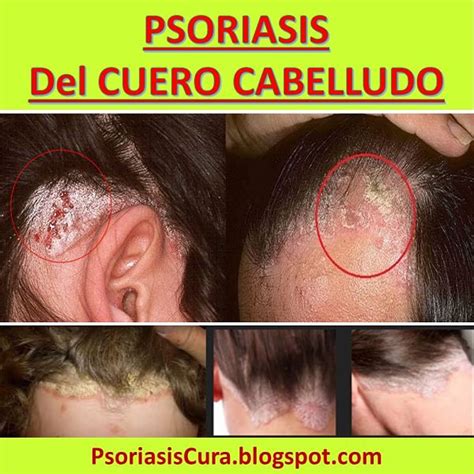 Psoriasis Cura Psoriasis En El Cuero Cabelludo Síntomas Y Tratamiento Natural 2019