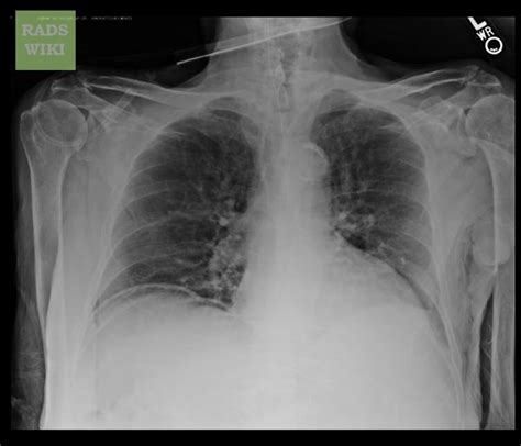 Pneumoperitoneum Wikidoc