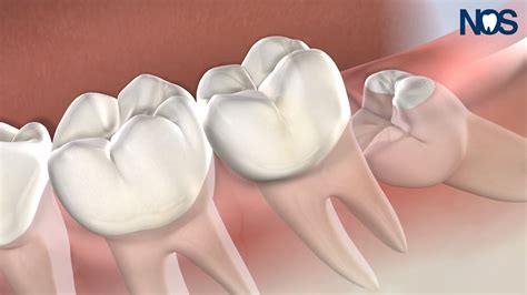 Post Op Instructions Wisdom Teeth At Naperville Oral Surgery And Dental