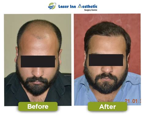 Laser Inn Best Hair Transplant Results Best Fue Hair Transplant