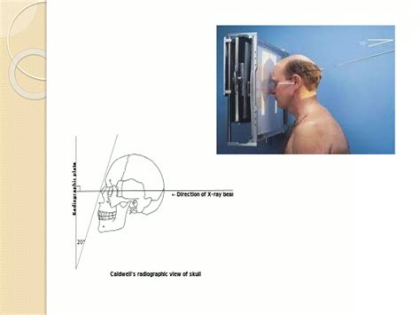 Radiology Of Nose And Paranasal Sinuses Ppt