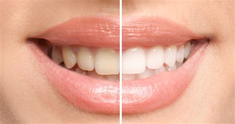 Teeth Whitening Dentist Kent WA Seablue Dental