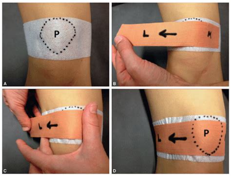 Lateral Patellofemoral Ligament Reconstruction For Medial Patellar