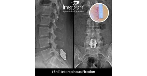 Revolutionizing Spine Surgery Techniques: InSpan Publishes First L5-S1 ...