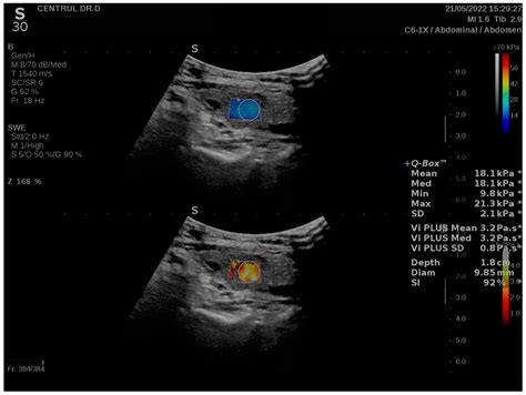 Biomedicines Free Full Text Assessment Of Thyroid Stiffness And Viscosity In Autoimmune