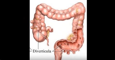 Diverticulosis Y Diverticulitis Como Se Curan Beliefnet