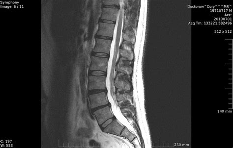 The Truth About Your Lumbar (low back) MRI Results - What the Doctor's ...