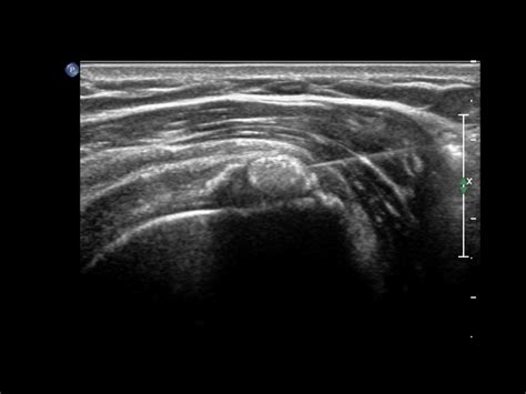 Rotator Cuff Barbotage Ultrasound Guided Image