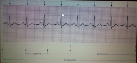 Notes From The Therapist Cardiac Physiology And Ecg Interpretation