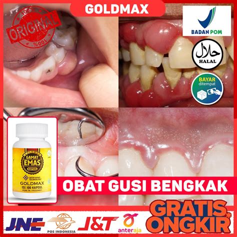 Jual Obat Gusi Bengkak Gusi Berdarah Infeksi Gusi Radang Gusi Panas