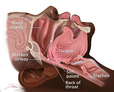 What Is Obstructive Sleep Apnea Sleep Apnea Mi Uk