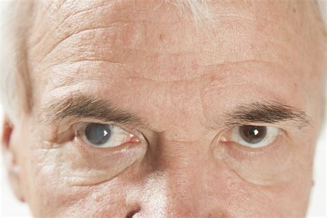 How Do You Know If You Need Cataract Surgery