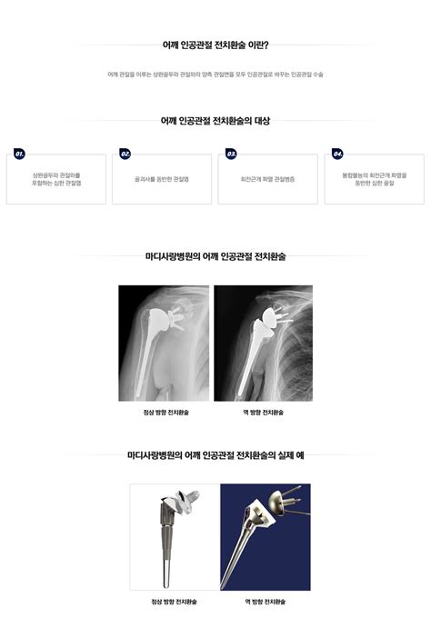 마디사랑병원 수술치료 인공관절수술 어깨 인공관절 전치환술