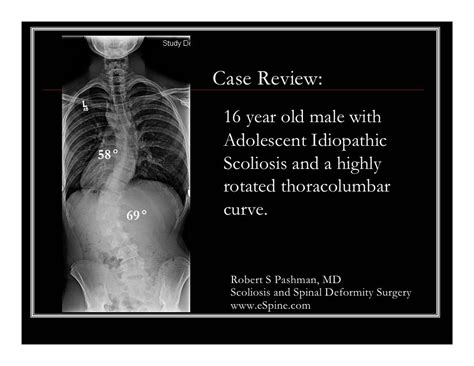 Case Review 16 16 Year Old Male With Highly Rotated Adolescent Idio