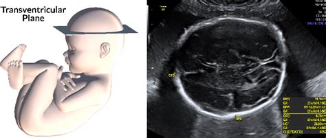 Learning Ultrasound Plane Pose Regression Assessing Generalized Pose Coordinates In The Fetal Brain