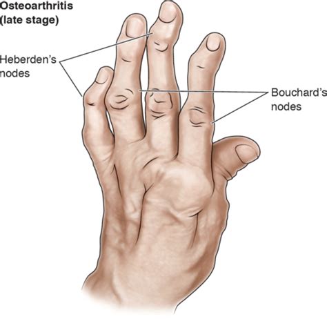 Osteoarthritis Flashcards Quizlet