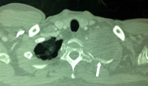 VIETNAMESE MEDIC ULTRASOUND: CASE 224: LEFT SUPRACLAVICULAR MASS, Dr ...