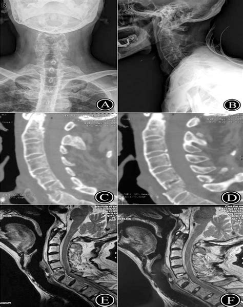 Esophageal Perforation In A Cervical Fracture Patient With P Spine