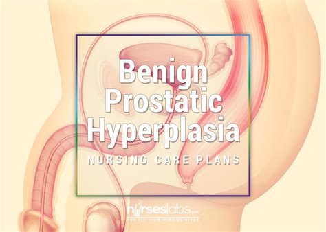 5 Benign Prostatic Hyperplasia BPH Nursing Care Plans Nursing 101