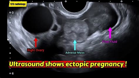 Ectopic Pregnancy Ultrasound 5 Weeks