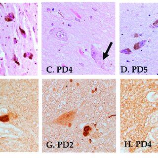 Neuropathology Of PD1 5 A D H E Staining Of The SN In PD1 2 4 And