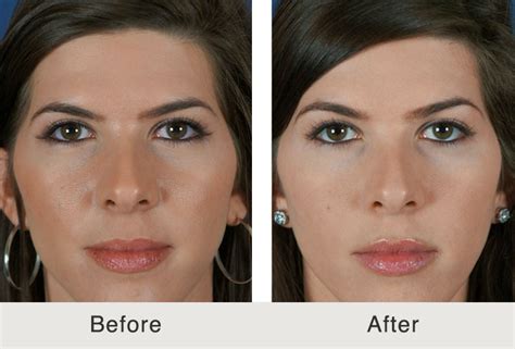 How Long Does A Browlift Last Carolina Facial Plastics