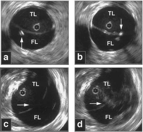 Intravascular Ultrasoundguided Percutaneous Fenestration Of The